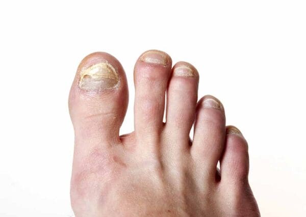 A person with toenail fungus on their toe.